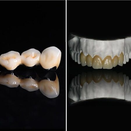 Diensten kroon en brugwerk