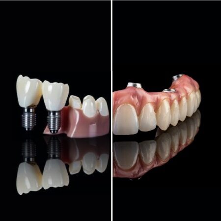 Implantaten diensten